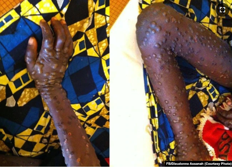 Kemenkes Pastikan Cacar Monyet Belum Terdeteksi di Indonesia, Kenali Gejalanya...